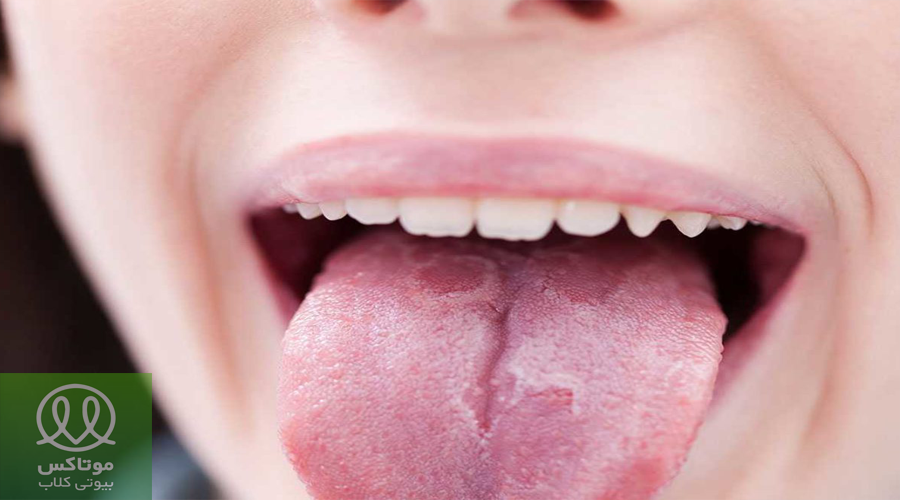 التهاب دهان و زبان بخاطر کمبود ویتامین